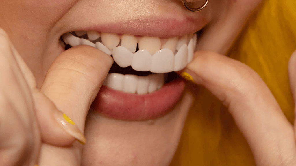 Instant Fit Veneers for Upper and Lower Teeth for a Natural Smile
