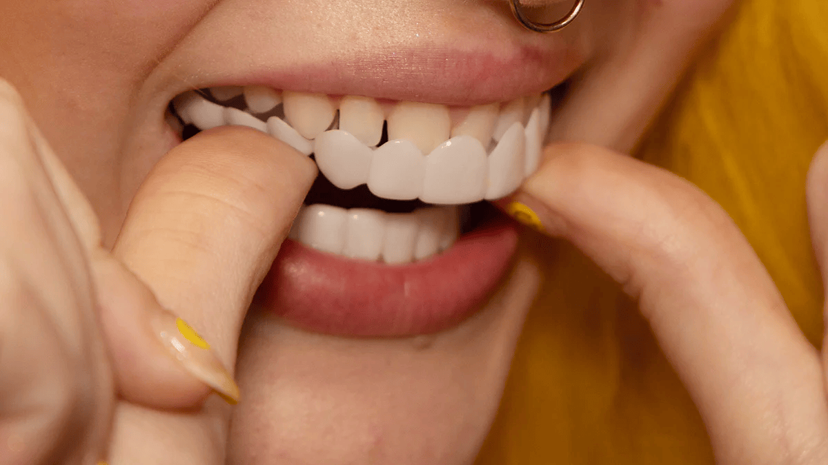 Instant Fit Veneers for Upper and Lower Teeth for a Natural Smile