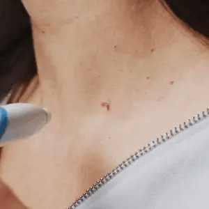 Skin Tag Removal Kit - Easily Remove Skin Tags