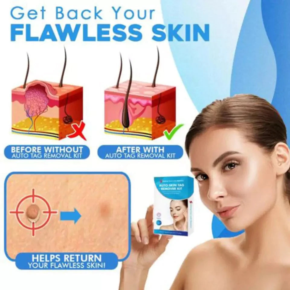 Skin Tag Removal Kit - Easily Remove Skin Tags