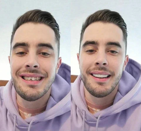 Instant Fit Veneers for Upper and Lower Teeth for a Natural Smile
