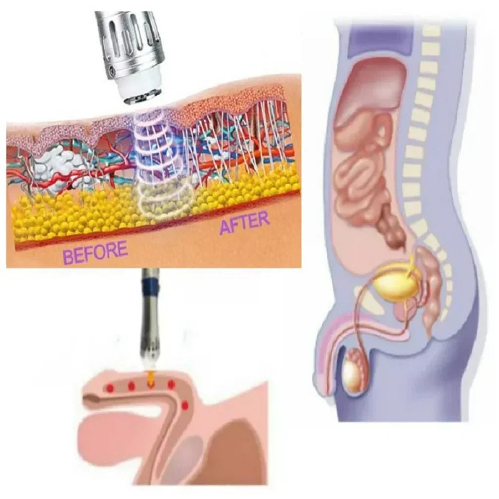Portable Shockwave Therapy Device for Men's ED