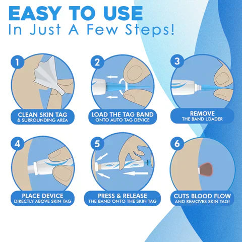 Skin Tag Removal Kit - Easily Remove Skin Tags