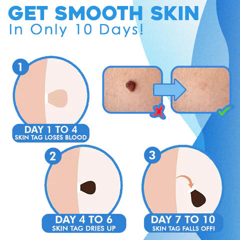 Skin Tag Removal Kit - Easily Remove Skin Tags