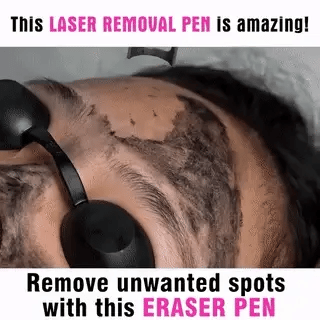 Laser Pen for Removing Tattoos, Moles, and Freckles