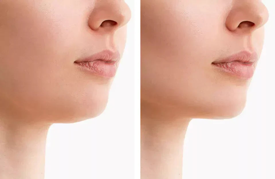 Red Light Therapy Belt for Chin Contouring and Double Chin Reduction