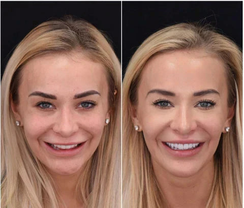 Instant Fit Veneers for Upper and Lower Teeth for a Natural Smile