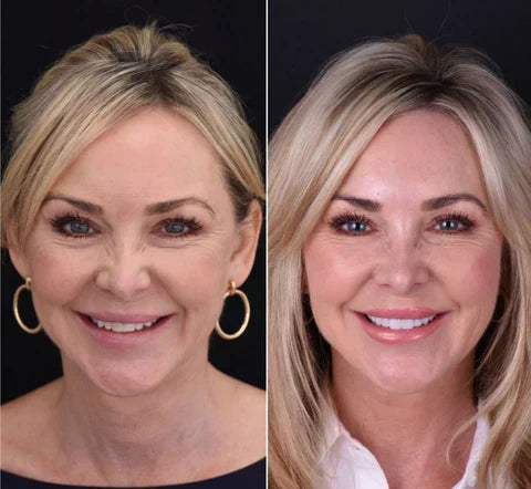 Instant Fit Veneers for Upper and Lower Teeth for a Natural Smile
